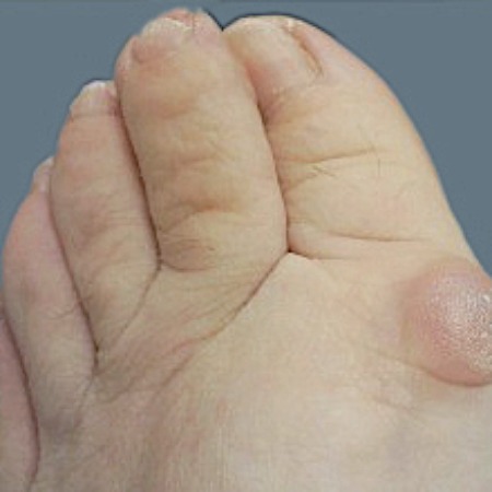 bursitis