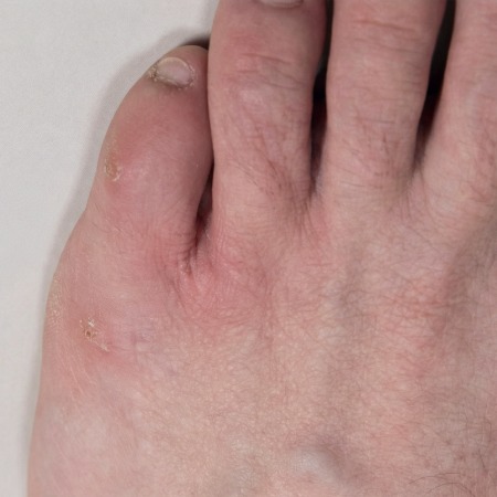 neuroma
