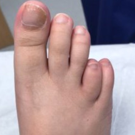 BEFORE-Brachymetatarsia