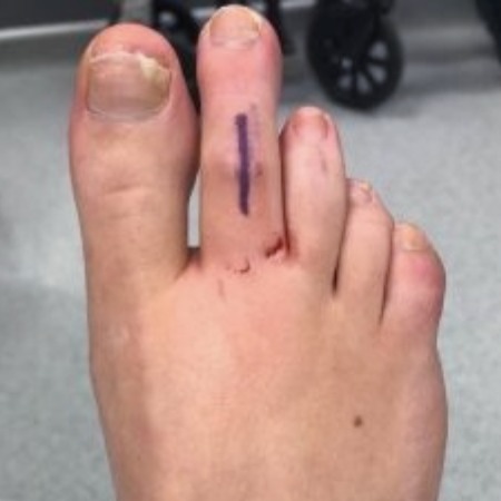 BEFORE-Toe-shortening