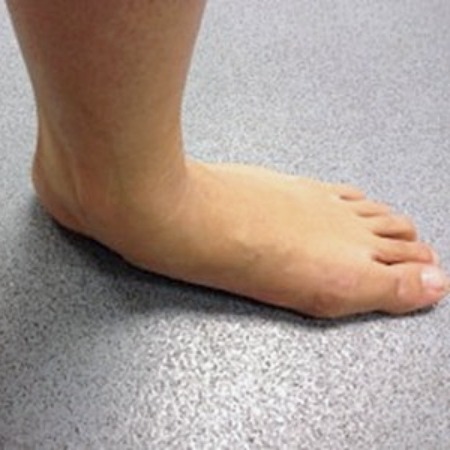 flat foot