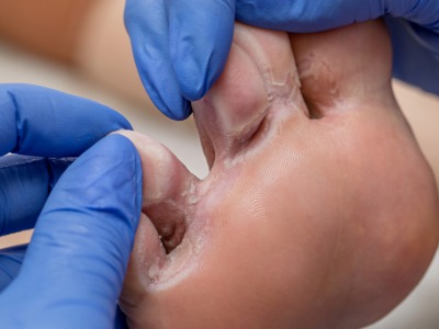 A podiatrist examines a sore foot with hyperhidrosis.