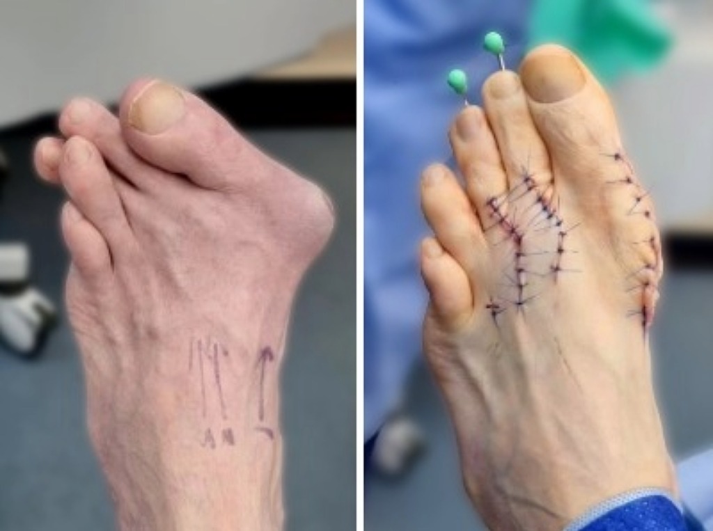 before and after bunion surgery