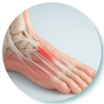 Metatarsalgia & Forefoot Pain icon