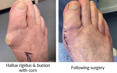 image of Hallux rigidus and bunion with painful corn pre and post surgery