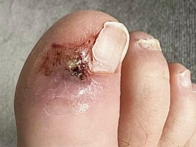 FPC common conditions ingrown Trauma nail