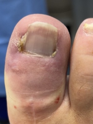 Nail section removed. Ingrowing Toenail Treatment in Leeds pt1