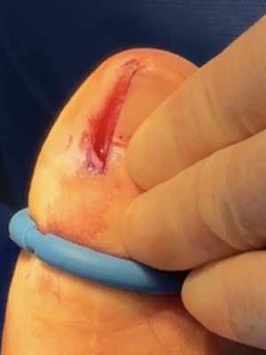 Nail section removed. Ingrowing Toenail Treatment in Leeds pt 2