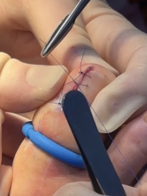 Nail section removed. Ingrowing Toenail Treatment in Leeds pt3