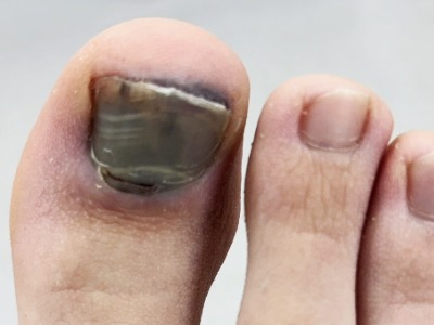 FPC common conditions: ingrown toenail-18-Toenail haematoma