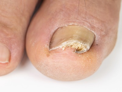 FPC common conditions ingrown toenail-inveluted
