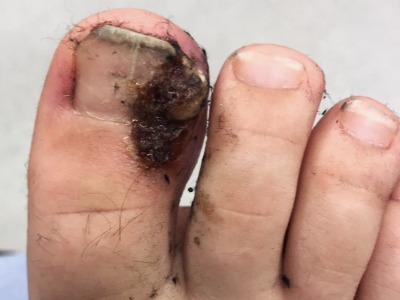 FPC common conditions ingrown toenail with hypergranulation